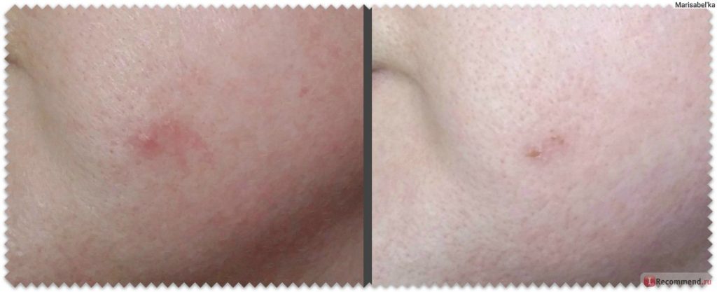 Treatment of acne with calendula tincture: before and after photos